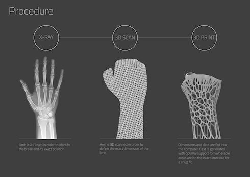 3D-печать избавит от гипса при переломах