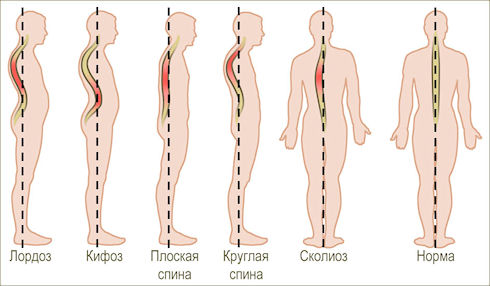 Сколиоз, кифоз, лордоз – тяжелые заболевания позвоночника